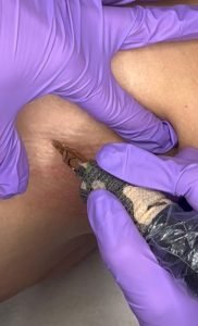 Scar Camouflage Medical Tattoo Scar Camouflage Medical Tattoo