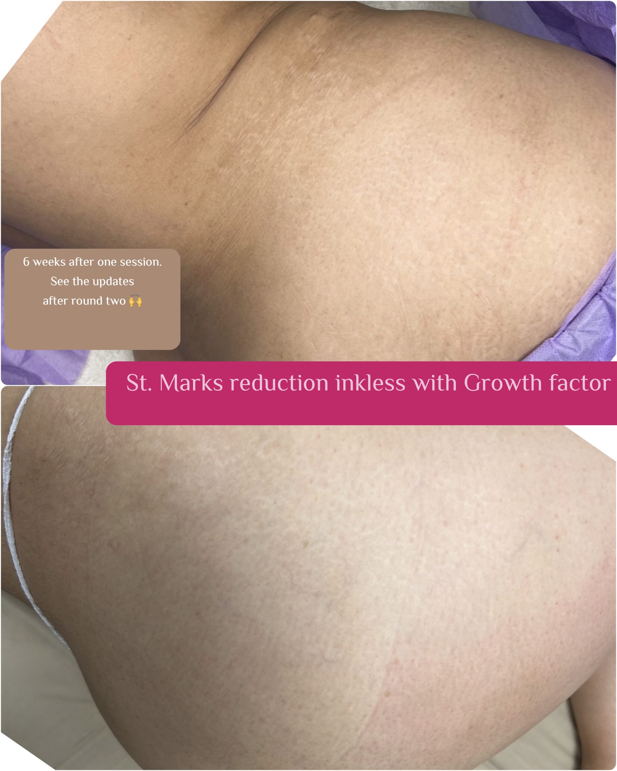 Stretch Marks on thights