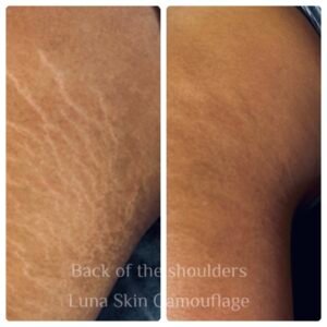 Stretch marks on shoulders Stretch marks on shoulders