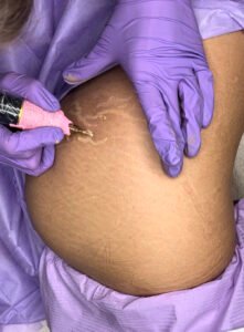 Stretch Marks Camouflage Stretch Marks Camouflage