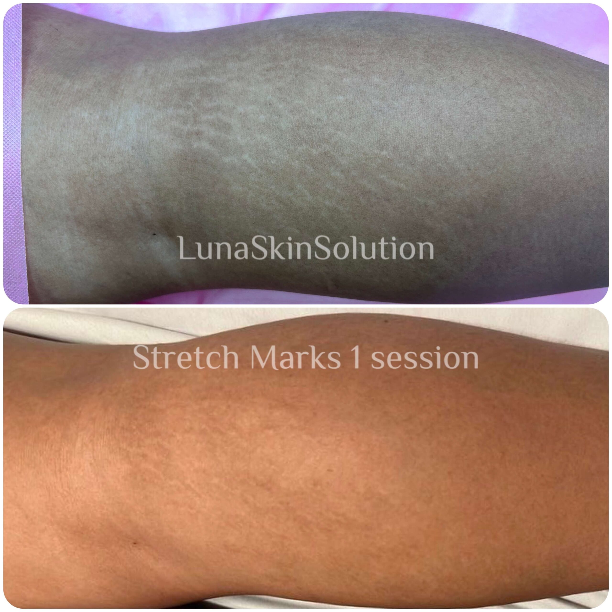 Stretch Marks Camouflage 1 session
