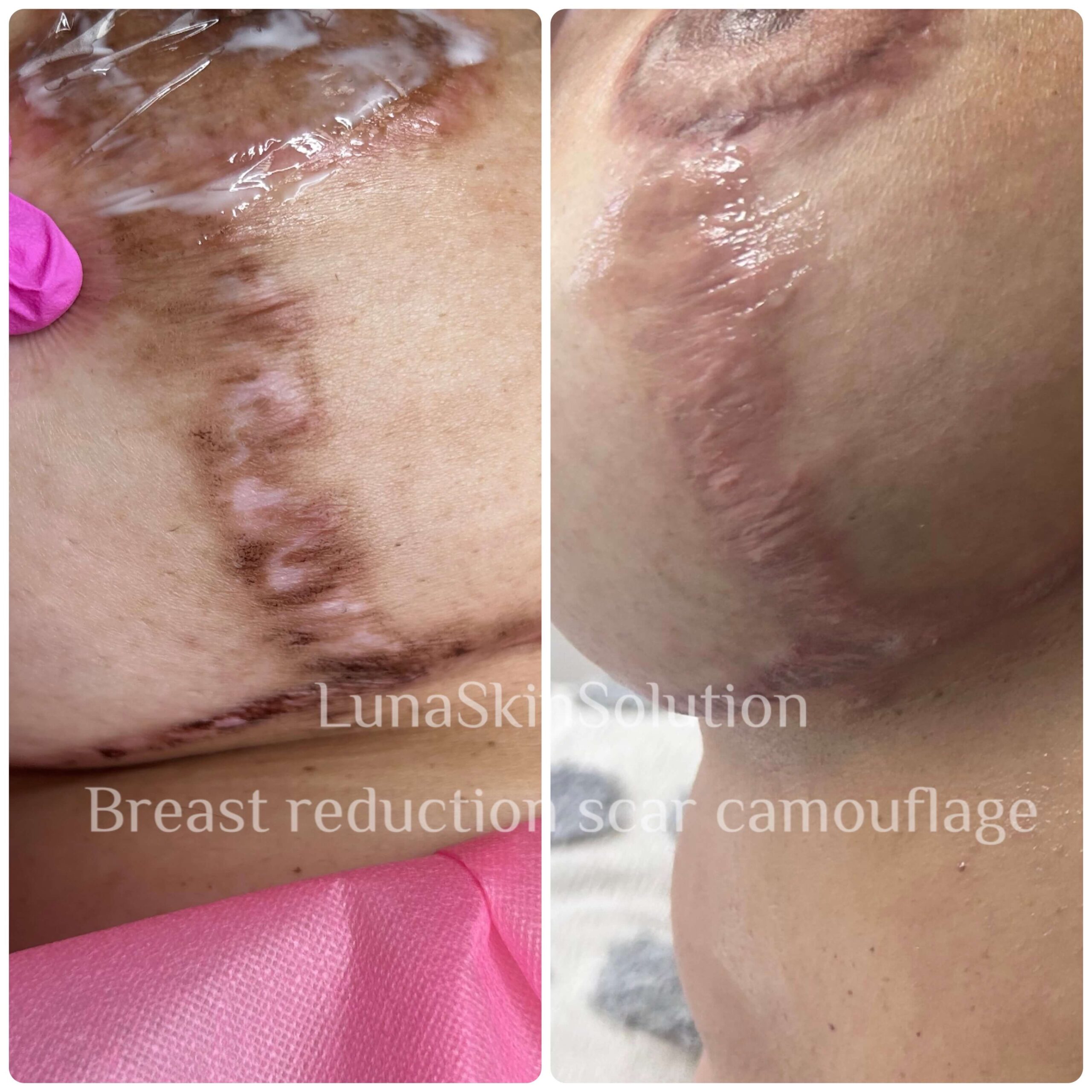 Breast scar coverup