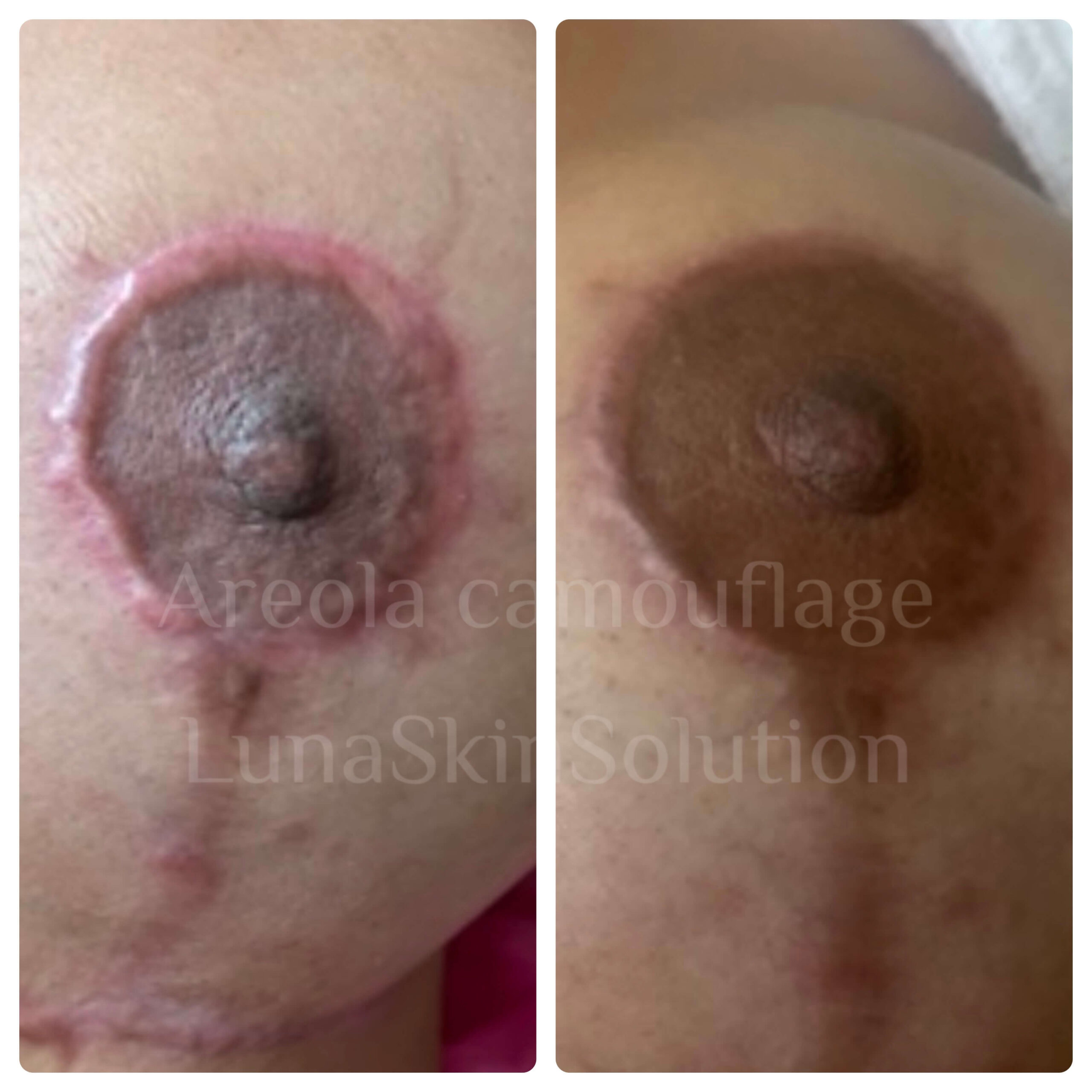 Areola camouflage and scar reduction
