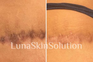 Scar Reduction