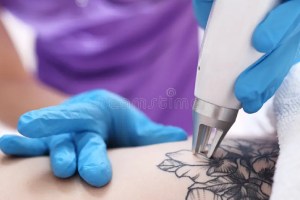 Tattoo Removal Treatment