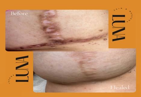 Scar camouflage tattoo before and after